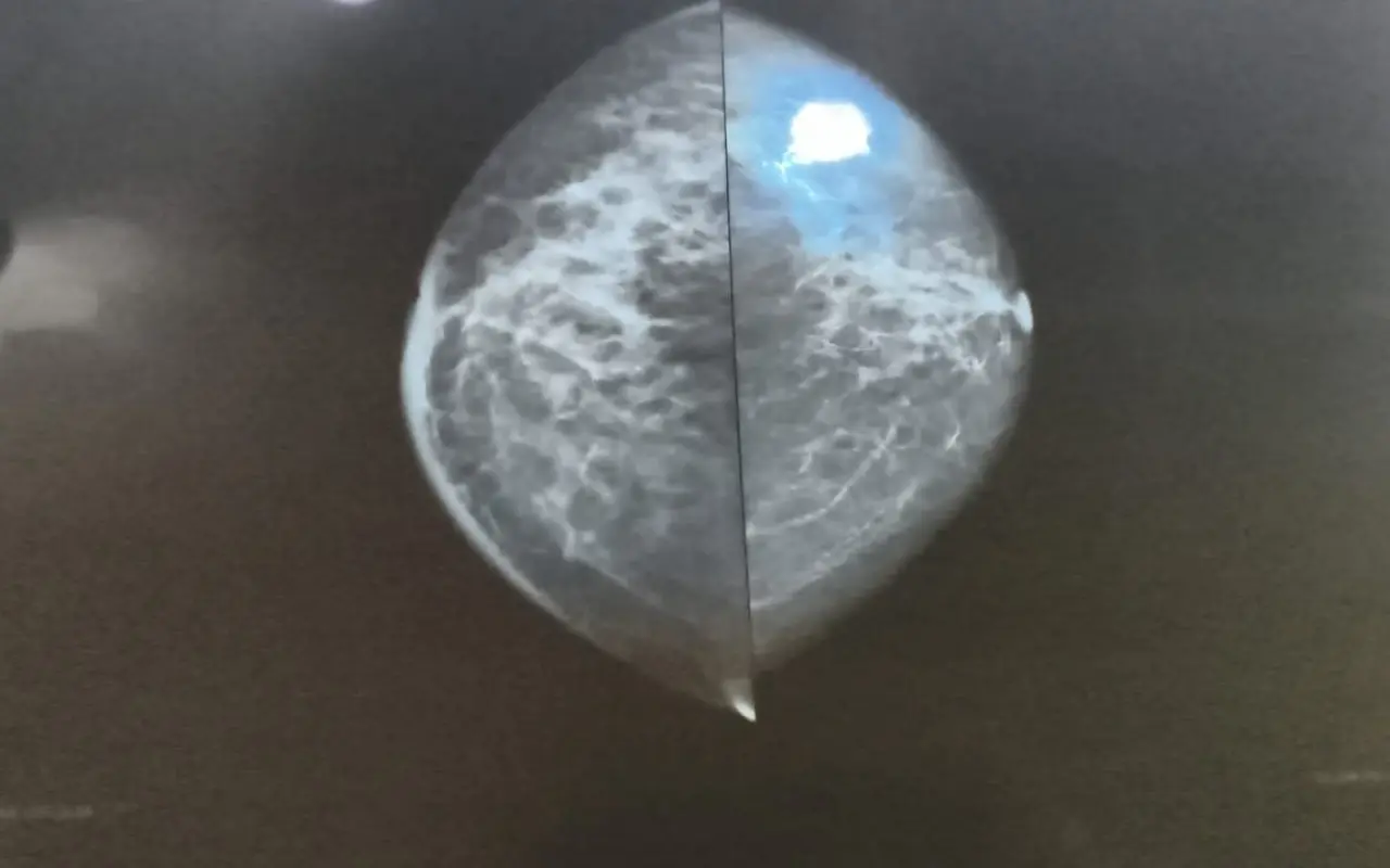 Ayudemos a Sandra a luchar contra el cáncer